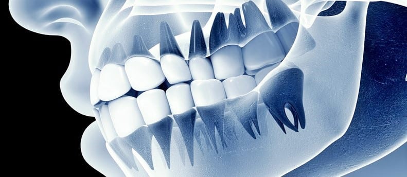 Digital X-Rays