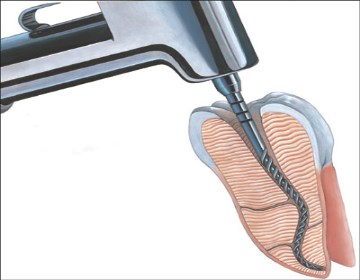 Rotary Endodontics